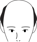 Male pattern stage 5