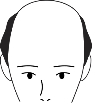 Male pattern stage 5