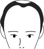 Male pattern stage 4