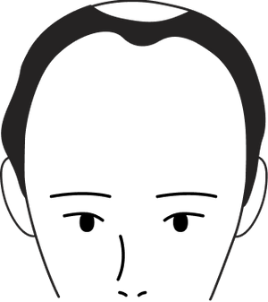 Male pattern stage 4