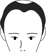 Male pattern stage 3