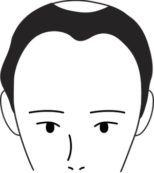 Male pattern stage 3