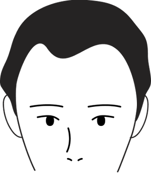 Male pattern stage 2